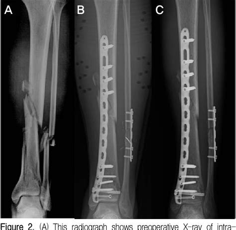 Figure From Treatment Of Distal Tibia Fracture Using MIPPO Technique With Locking Compression