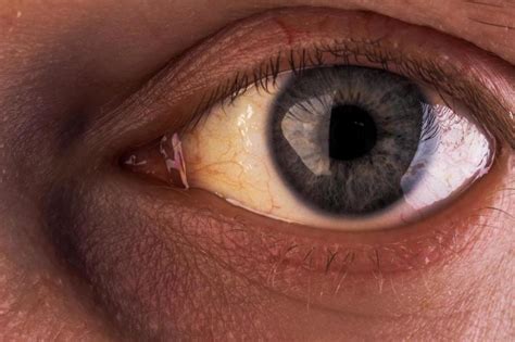 Yellow Eyes Conditions That Cause In Newborns Children And Adults