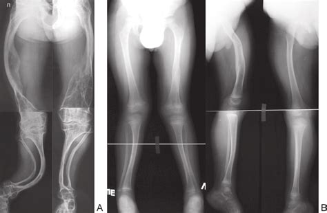 X Ray Telemetry Of The Lower Extremities A Patient With Oi Type Iii