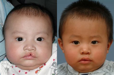 Some surgeons favor early repair, before the newborn is discharged from the hospital; Cleft Lip Correction Before & After Photos - Ernesto J ...