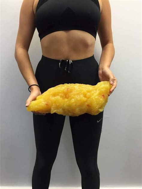 How Accurate Are Those Photos Showing This Is What 5lbs Of Fat Looks