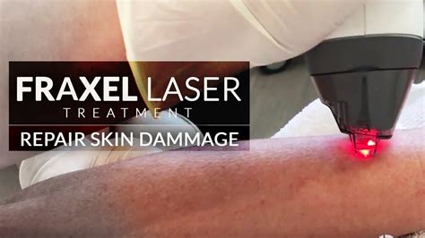 Fraxel Laser Treatment Laser For Arms Skin Damage Wrinkle