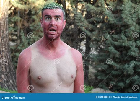 Man With Pale Complexion Getting Sunburnt Stock Image Image Of Burnt