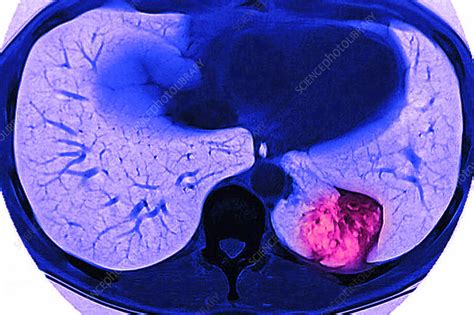 Lung Cancer Mri Stock Image C0332982 Science Photo Library