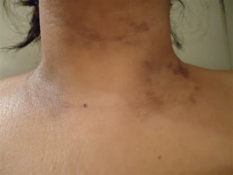 These patches in most cases are benign and do not cause much complications. "Dark spots on my neck - What is this?": Skin & Beauty ...