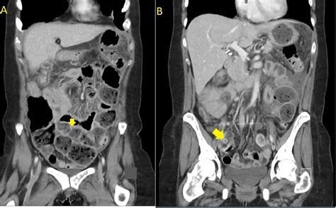 Cureus Acute Appendicitis And Small Bowel Obstruction Secondary To