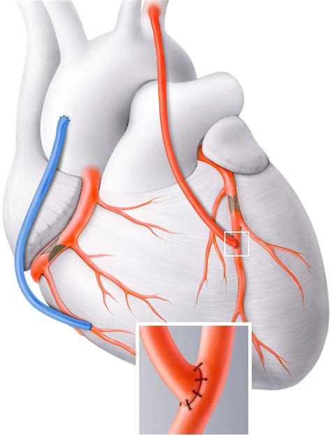 Bypass Surgery Coronary Heart Diseases