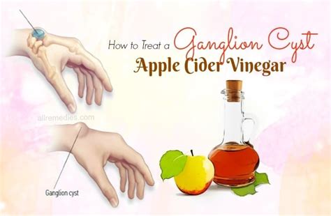19 Ways How To Treat A Ganglion Cyst Naturally At Home