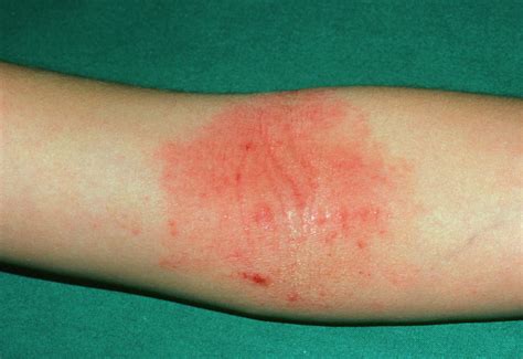 Atopic Eczema On The Inside Of The Elbow Photograph By Dr P Marazzi