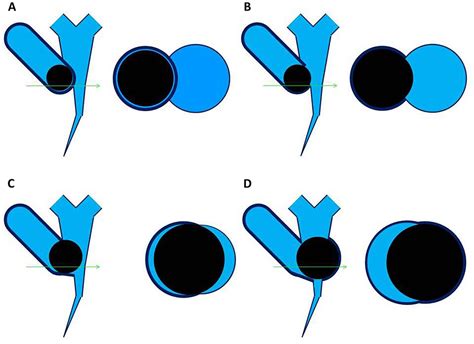 Csendes Classification Of Mirizzi Syndrome A Type I External