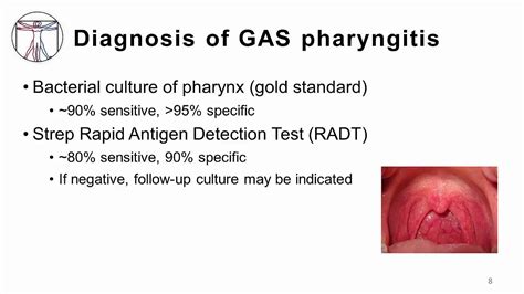 Gas Pharyngitis Diagnosis And Treatment Youtube