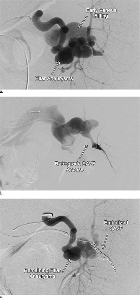 Pre Ab And Postembolization C Dynact Angiography Siemens
