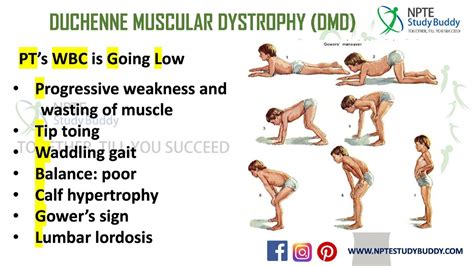 Duchenne Muscular Dystrophy Duchenne Muscular Dystrophy Physical
