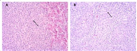 Histopathological Observation Of Diseased Chickens Infected With Mdv A