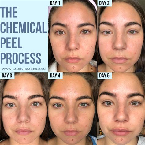 Jessner Chemical Peel Beforeafter Photos Of The Proven Facial