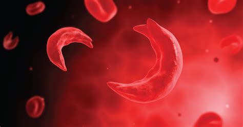 People with scd have atypical hbss, or sickle cell anemia, is the most common subtype of sickle cell disease. Sickle Cell Trait vs. Sickle Cell Disease | Get Healthy ...