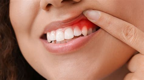 What Does It Mean When Your Gums Are Swollen