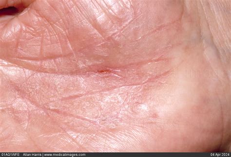 Stock Image Dermatology Mild To Moderate Palmar Psoriasis Dry Cracked