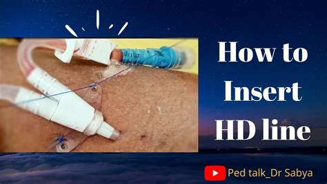 Insertion Of Hd Line Hemodialysis Line Plasma Exchange Line Drsabya