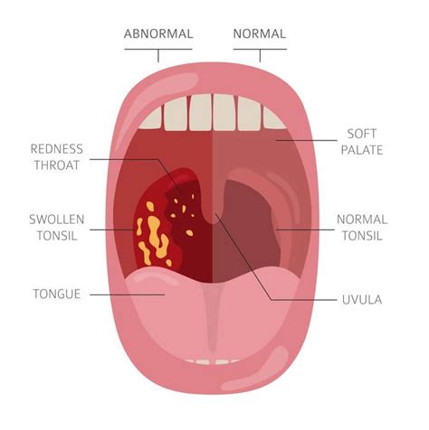 Tonsillectomy The Tonsils And Adenoid When Tonsillectomy Is Necessary
