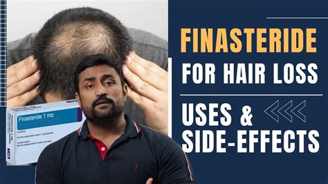 FINASTERIDE FOR HAIR LOSS USES SIDE EFFECTS YouTube