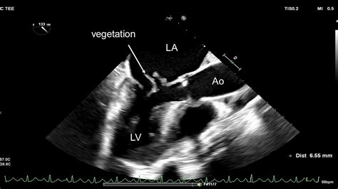 Cureus Posterior Mitral Leaflet Prolapse And Subsequent Mitral Valve Endocarditis Complicated