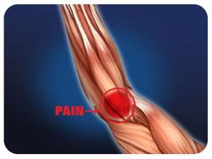 The brachioradialis tendon bends the elbow like the brachialis and biceps. Tennis/Golfer's Elbow Orlando Tendonitis - Medical Massage