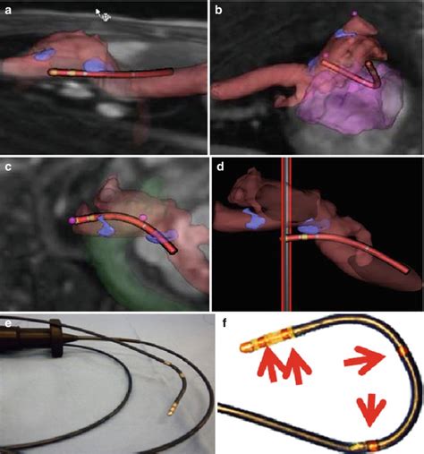Image Guided Cardiac Electrophysiology Procedures Focusing On Mri