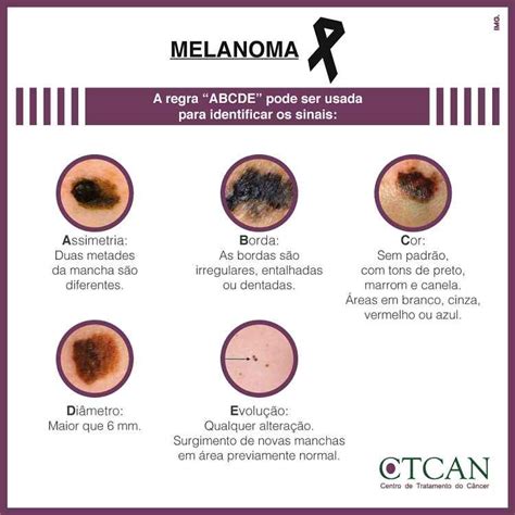 Melanoma Câncer De Pele Tipos Causas E Tratamentos