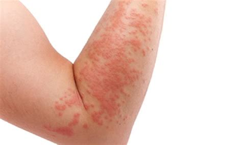 Best Treatment For Hives In Bangalore Drjoshys Medical Center