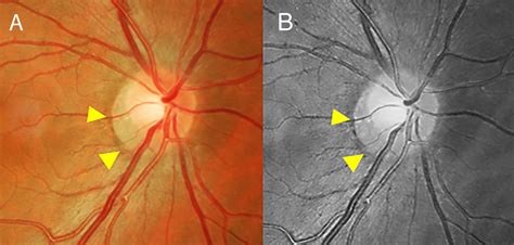 Choroidal Crescent Optic Nerve