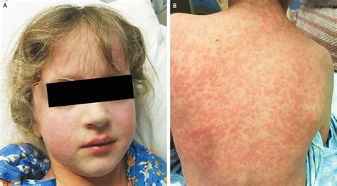 Pediatrics 10 Rash Por Amoxicilina En Mononucleosis