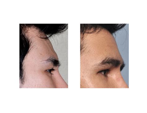 Case Study Custom Male Forehead Implant Explore Plastic Surgery