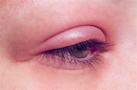 Blepharitis Types Eyelids And Eyelashes