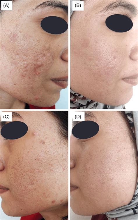 A 20‐year‐old Female Presented With Sever Post‐acne Scars Grade 4