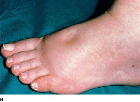 What You Need To Know About Edema