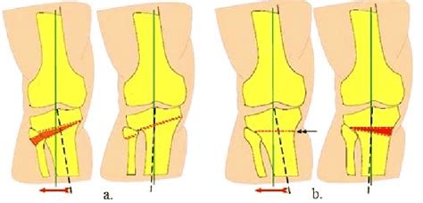 High Tibia Osteotomy A With Closing Wedge B With Opening Wedge