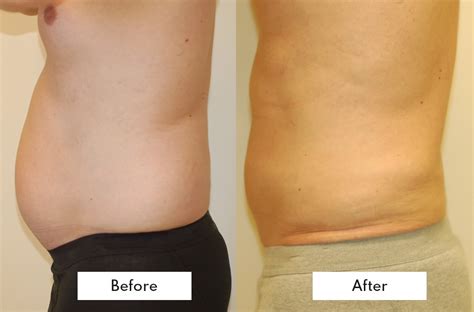 Cryolipolysis Coolsculpting In Thalassery And Coimbatore
