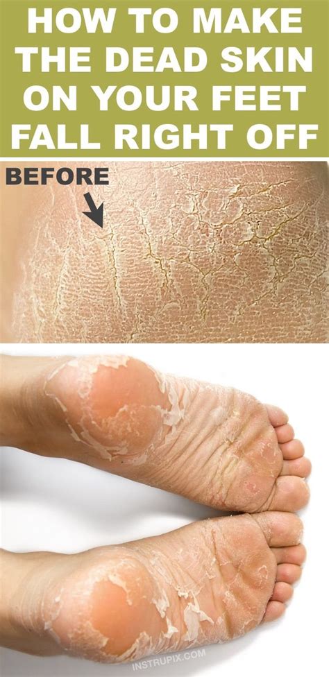 How To Get Rid Of Dry Skin Feet