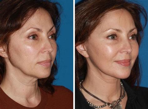 The face workout was lovely to do at night before bed. Facelift in Manhattan, NYC | Facial Rejuvenation ...