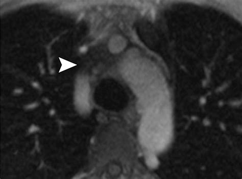 Imaging Of Granulomatous Fibrosing Mediastinitis Ajr