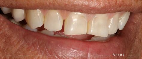 Desgaste Dental Qué Lo Produce Y Cómo Prevenirlo Bellezapura