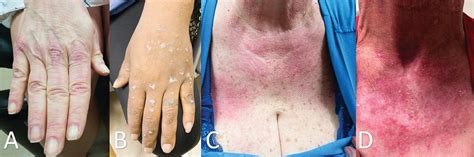 Cutaneous Involvement In Systemic Lupus Erythematosus A Review For The