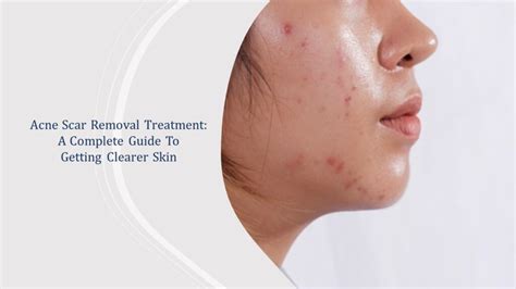 How To Fade Acne Scars A Comprehensive Guide Ihsanpedia