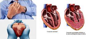 Qué es la Cardiomiopatía o Miocardiopatía Causas Síntomas Factores