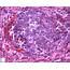 Malignant Rhabdoid Tumor  Humpathcom Human Pathology