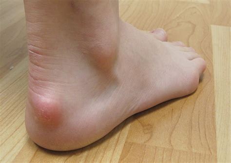 Haglund Deformity Boney Prominence Over Back Of The Heel On A Year