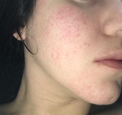 Helppp Could This Be Acne Rosacea Pictures Included Rosacea
