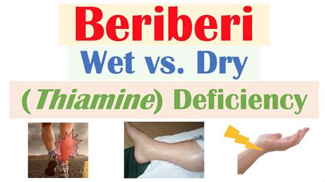 Beriberi Thiamine Deficiency Wet Vs Dry Beriberi Pathophysiology Symptoms Diagnosis