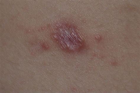 Clinical Challenge A Rash Response To Southern Exposure Mpr